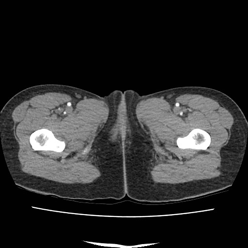 File:Acute myocarditis (Radiopaedia 55988-62613 Axial C+ portal venous phase 90).jpg