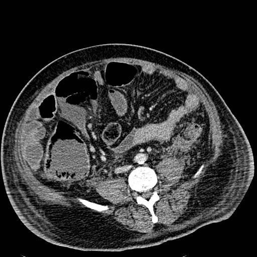 Acute pancreatic necrosis (Radiopaedia 13560-18501 Axial C+ portal venous phase 91).jpg