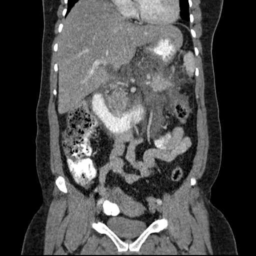 File:Acute pancreatitis (Radiopaedia 20829-20744 Coronal C+ portal venous phase 27).jpg