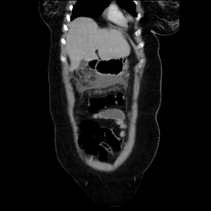Acute pancreatitis (Radiopaedia 69236-79012 Coronal C+ portal venous phase 58).jpg