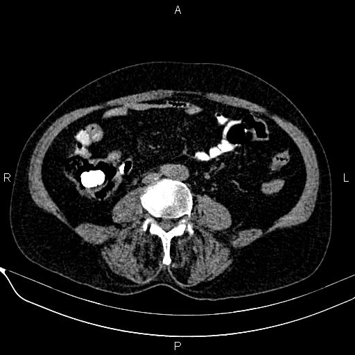 Acute pancreatitis (Radiopaedia 85146-100701 Axial non-contrast 77).jpg