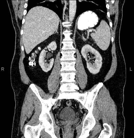 Acute pancreatitis (Radiopaedia 85390-101010 Coronal C+ portal venous phase 48).jpg