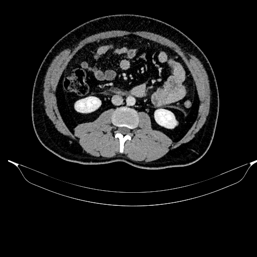 Acute pancreatitis (Radiopaedia 87428-103757 Axial C+ portal venous phase 51).jpg