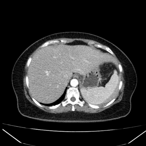 Acute pancreatitis - Balthazar C (Radiopaedia 26569-26714 Axial C+ arterial phase 16).jpg
