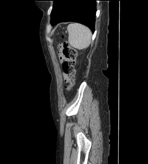 Acute pancreatitis - Balthazar E - post ERCP (Radiopaedia 27562-27772 Sagittal C+ portal venous phase 119).png