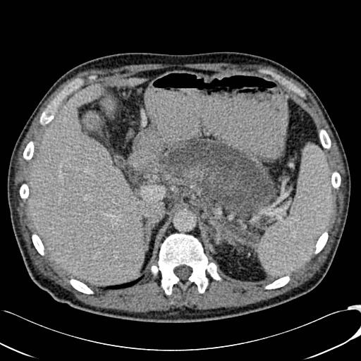 File:Acute pancreatitis with walled off pancreatic necrosis (Radiopaedia 6438-7797 Axial C+ portal venous phase 1).jpg