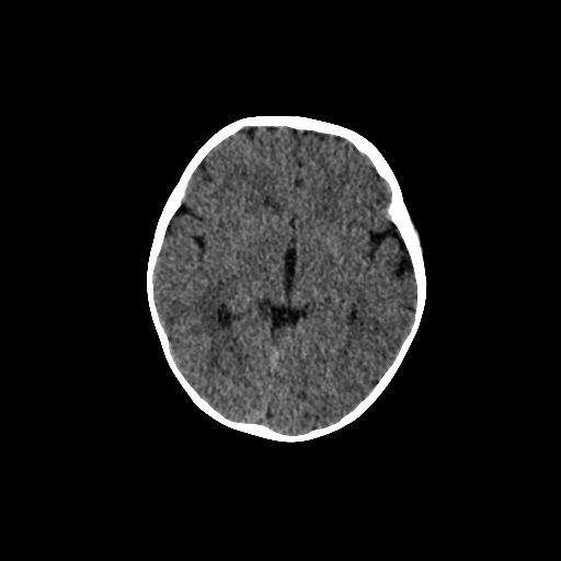 Acute phase of hemiconvulsion-hemiplegia epilepsy syndrome (Radiopaedia 29309-29744 Axial non-contrast 29).jpg