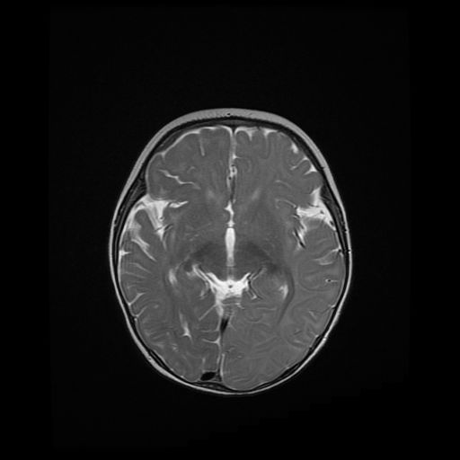File:Acute phase of hemiconvulsion-hemiplegia epilepsy syndrome (Radiopaedia 29309-29745 Axial T2 13).jpg