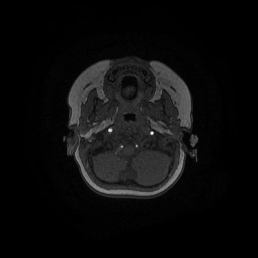 Acute phase of hemiconvulsion-hemiplegia epilepsy syndrome (Radiopaedia 29309-29745 Axial TOF angiography 145).jpg