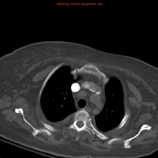 Acute pulmonary embolism (Radiopaedia 13286-13289 Axial C+ CTPA 16).jpg