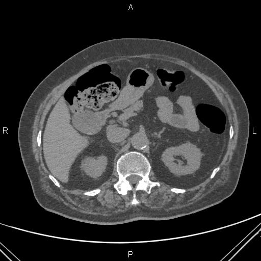 File:Acute renal artery occlusion (Radiopaedia 86586-102682 Axial non-contrast 24).jpg