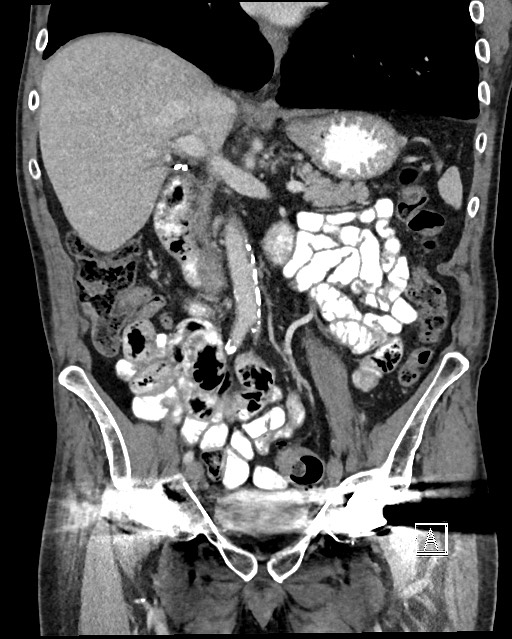 Acute renal infarction - rim capsular enhancement (Radiopaedia 59833-67270 Coronal C+ portal venous phase 23).jpg