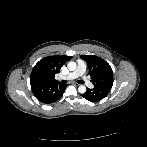 Acute segmental pulmonary emboli and pulmonary infarction (Radiopaedia 62264-70444 Axial C+ CTPA 50).jpg