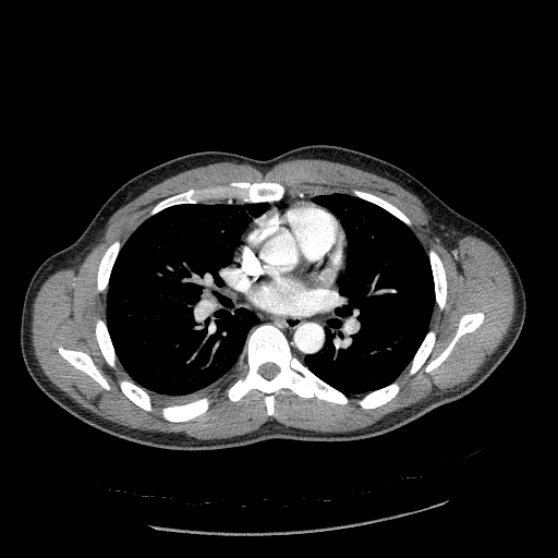 Acute segmental pulmonary emboli and pulmonary infarction (Radiopaedia 62264-70444 Axial C+ CTPA 58).jpg