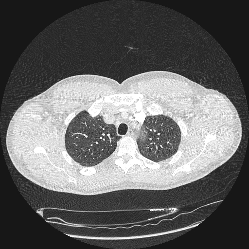 Acute segmental pulmonary emboli and pulmonary infarction (Radiopaedia 62264-70444 Axial lung window 36).jpg