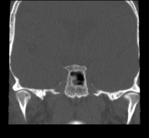 Acute sinusitis (Radiopaedia 23161-23215 Coronal bone window 57).jpg