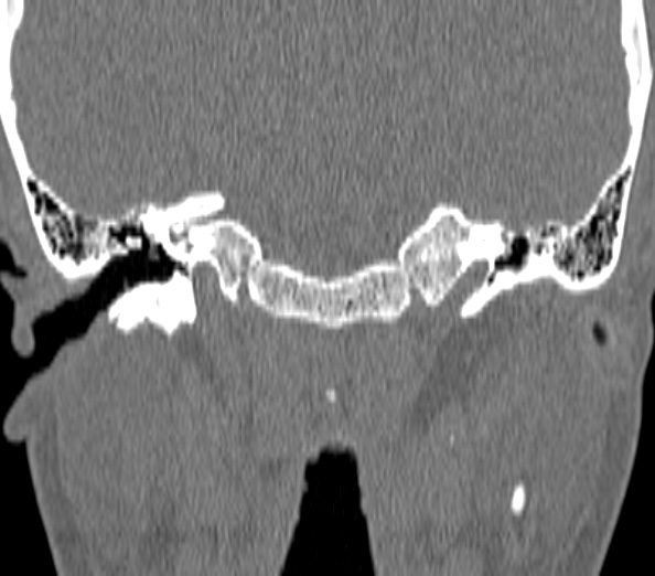 Acute sinusitis (Radiopaedia 40564-43158 Coronal bone window 56).jpg