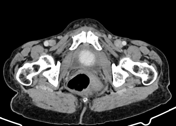 Acute small bowel (ileal) volvulus (Radiopaedia 71740-82139 Axial C+ portal venous phase 194).jpg