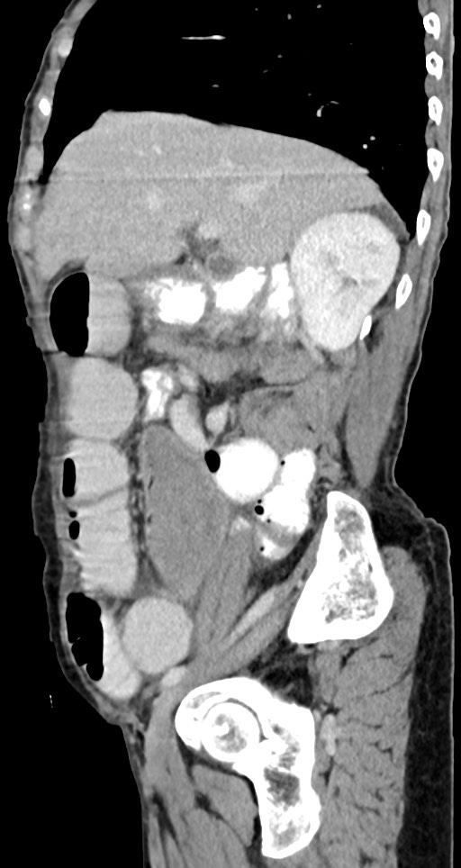 Acute small bowel (ileal) volvulus (Radiopaedia 71740-82139 Sagittal C+ portal venous phase 114).jpg