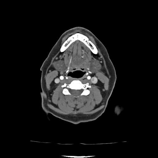 Acute subarachnoid hemorrhage and accessory anterior cerebral artery (Radiopaedia 69231-79009 Axial C+ arterial phase 51).jpg