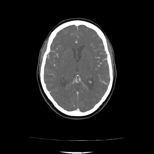Acute subarachnoid hemorrhage and accessory anterior cerebral artery (Radiopaedia 69231-79009 Axial C+ arterial phase 98).jpg