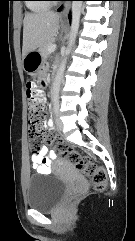 Acute uncomplicated appendicitis (Radiopaedia 61374-69304 Sagittal C+ portal venous phase 47).jpg