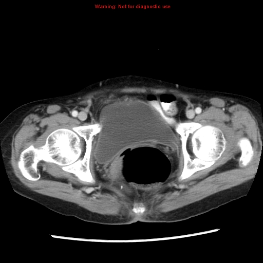 Adenocarcinoma of the colon (Radiopaedia 8191-9039 Axial liver window 71).jpg