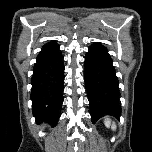 Adenocarcinoma of the lung (Radiopaedia 59871-67325 Coronal C+ arterial phase 63).jpg