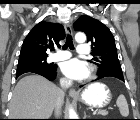 Adenocarcioma of rectum- T1 lesion (Radiopaedia 36921-38547 Coronal C+ arterial phase 35).png