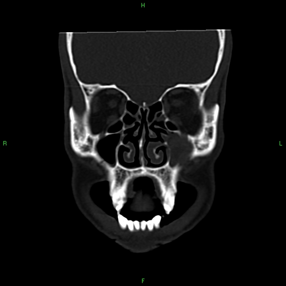 File:Adenoid cystic carcinoma of hard palate (Radiopaedia 26137-26273 Coronal bone window 7).jpg