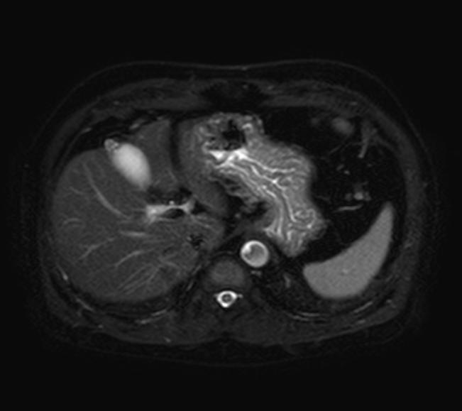 File:Adenomyomatosis of the gallbladder fundus (Radiopaedia 56727-63518 Axial T2 fat sat 1).jpg