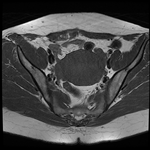 File:Adenomyosis-scar endometriosis (Radiopaedia 65863-75022 Axial T1 13).jpg