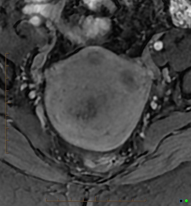 Adenomyosis uterus with hematometra (Radiopaedia 45779-50011 Axial T1 C+ fat sat 20).jpg