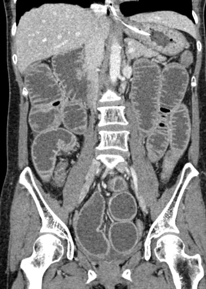 Adhesional small bowel obstruction (Radiopaedia 48397-53305 Coronal C+ portal venous phase 186).jpg