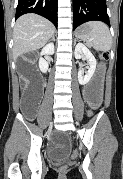 Adhesional small bowel obstruction (Radiopaedia 52107-57980 Coronal C+ portal venous phase 53).jpg