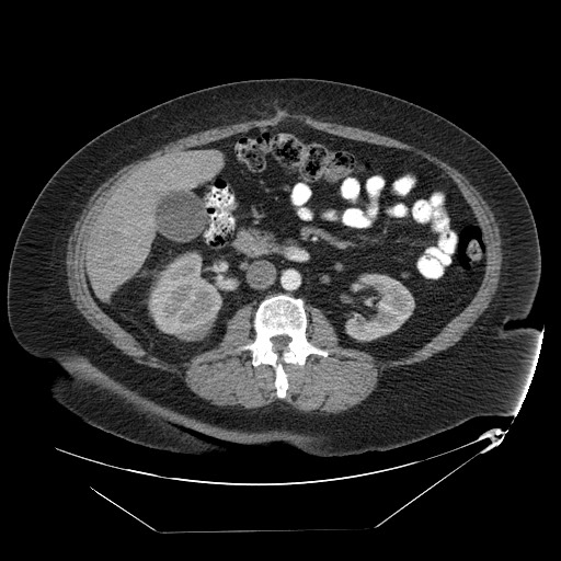 Adrenal angiosarcoma (Radiopaedia 81081-94671 Axial C+ arterial phase 38).jpg