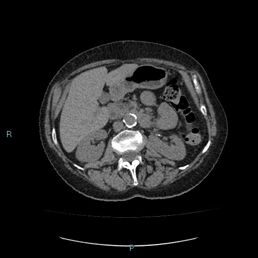 File:Adrenal collision tumor (ACT) (Radiopaedia 48462-53379 Axial non-contrast 23).jpg