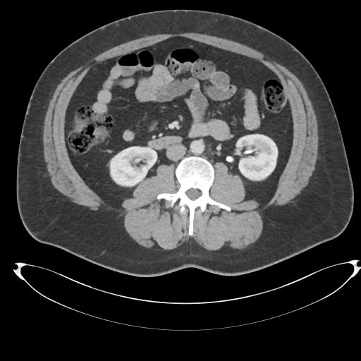 File:Adrenal cyst (Radiopaedia 45625-49778 AXIAL THICK 60 sec 50).png