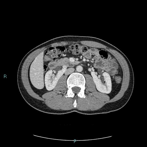 Adrenal cystic lymphangioma (Radiopaedia 83161-97534 Axial C+ portal venous phase 44).jpg
