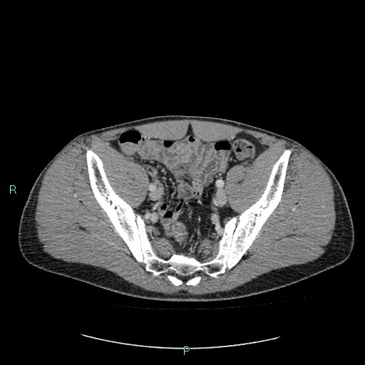 File:Adrenal cystic lymphangioma (Radiopaedia 83161-97534 Axial C+ portal venous phase 80).jpg
