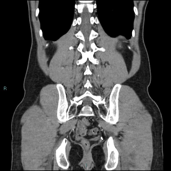 Adrenal cystic lymphangioma (Radiopaedia 83161-97534 Coronal C+ portal venous phase 60).jpg