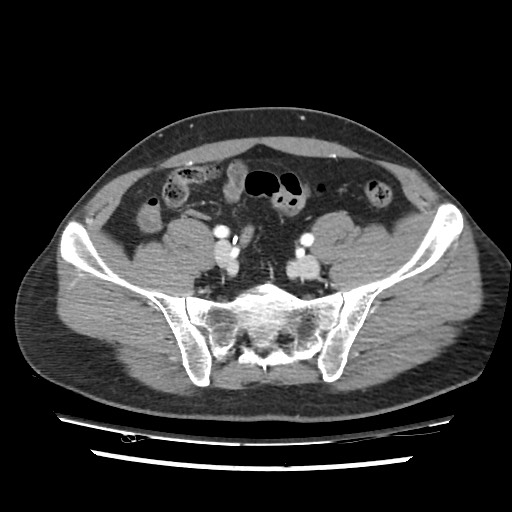 Adrenal gland trauma (Radiopaedia 81351-95078 Axial Dual bolus trauma C+ 101).jpg