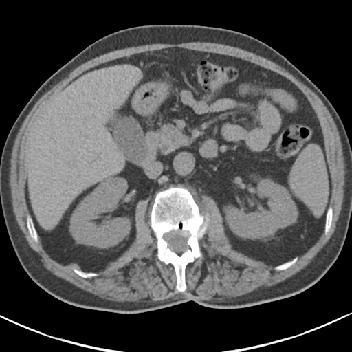 File:Adrenal hematoma (Radiopaedia 44334-47967 Axial non-contrast 38).png