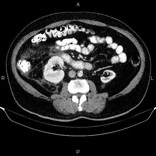 Adrenal hemorrhage (Radiopaedia 62622-70916 Axial C+ portal venous phase 96).jpg