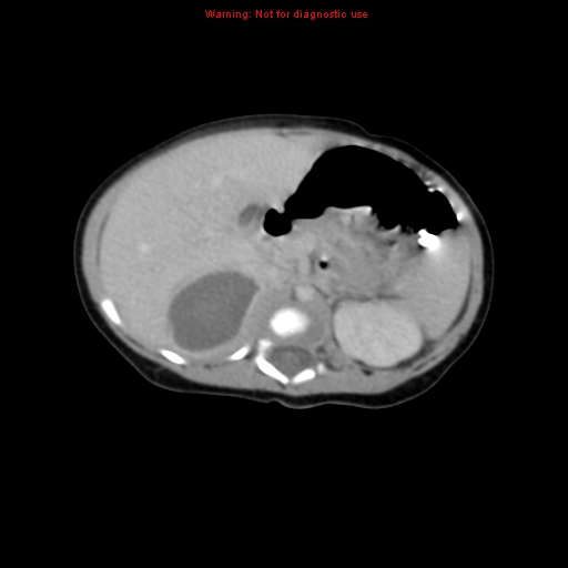 File:Adrenal hemorrhage (Radiopaedia 9390-10077 Axial C+ portal venous phase 7).jpg