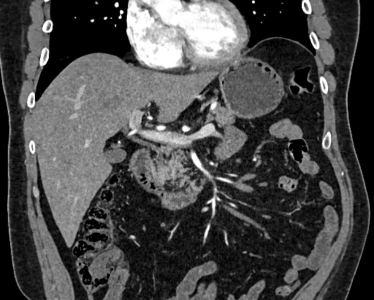 File:Adrenal metastases (Radiopaedia 73082-83791 Coronal C+ arterial phase 4).jpg