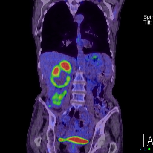 File:Adrenal metastasis from small cell lung cancer (Radiopaedia 19133-19109 Coronal 17).jpg