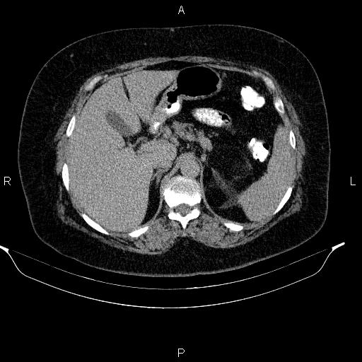 File:Adrenal myelolipoma (Radiopaedia 84319-99617 Axial C+ delayed 31).jpg