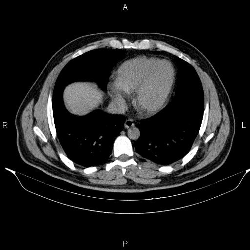 Adrenal myelolipoma (Radiopaedia 84321-99619 Axial non-contrast 10).jpg