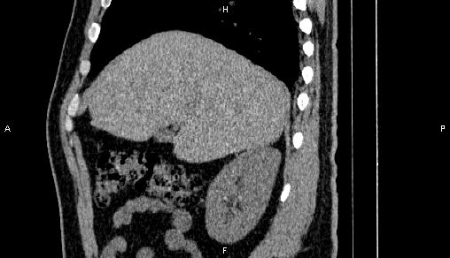 Adrenal myelolipoma (Radiopaedia 84321-99619 Sagittal non-contrast 29).jpg